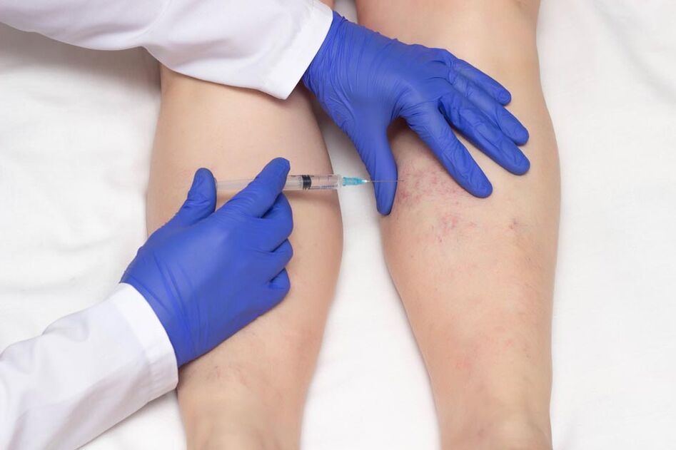 Sklerotherapie ass eng Method fir d'Behandlung vu Krampfadern