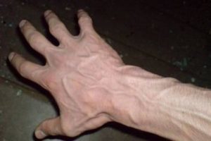 Methode fir d 'Behandlung vun Krampfadern an den Hänn